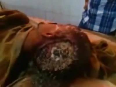 WTMF: Maggots Eating Away at Man's Skull and Hes Alive 