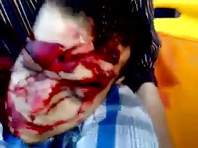 Man with Open Eyes Shot in The Head and His Skull Broken