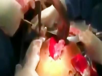 Man Has eel Removed From His Ass