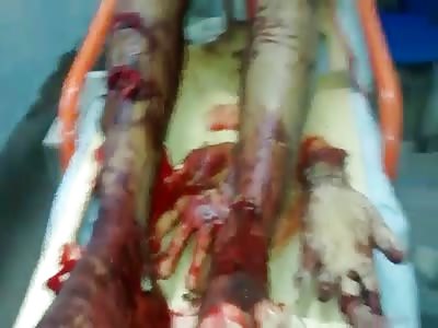 Thief who gave bad had his arm cut off!