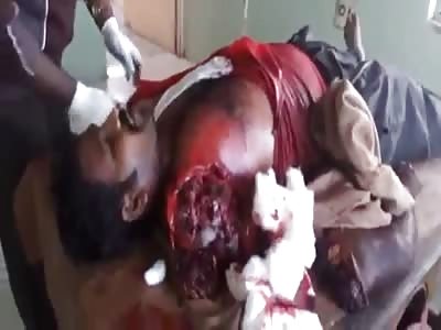 Man Awake and Talking with Arm Completely Ripped Off After Accident