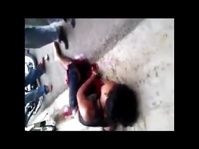 BOY WAS DISPLACED LEG IN MOTORCYCLE ACCIDENT 