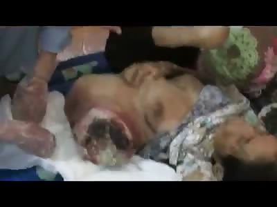 THE 'ZOMBIES FACTORY' TREATING WOMAN WITH HUGE TUMOR