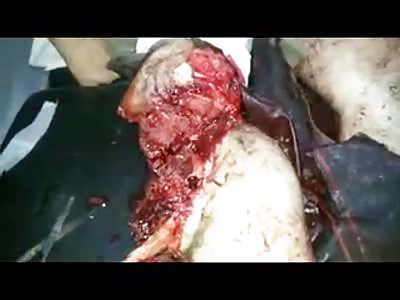 MAN INJURED IN EXPLOSION IS ATTENDED BY MEDICAL