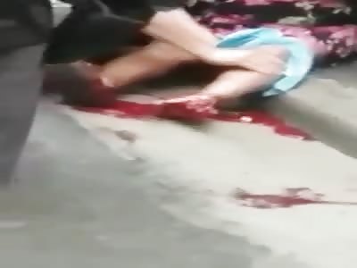 WOMAN FOOT SEVERED IN ACCIDENT 