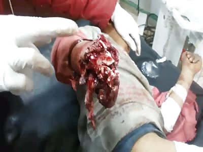 BOY ARM TORN APART BY CLUSTER BOMB
