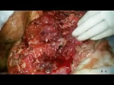 MAN INJURED IN BOMBING (TWO DAYS AFTER INTERVENTION SURGICAL)