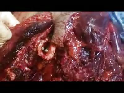 MAN HAS LEG SEVERED AFTER BOMBING