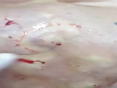 INFECTED SILICONE BUTT INJECTION REMOVAL