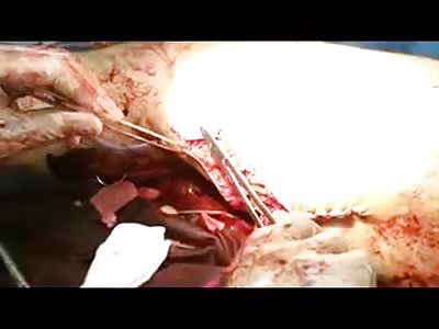 MAN INJURED IN BOMBING SUBMIT TO PRECARIOUS INTERVENTION SURGICAL 