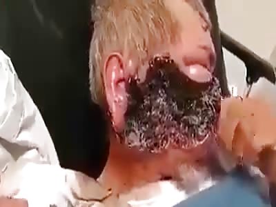 Horrible Wounded Face Infested by Maggots!