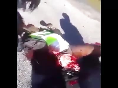 Caribbean Man Loses His Leg