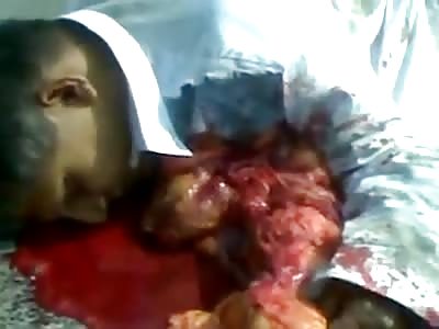 Accident aftermath .. Truck vs bike. Can see a man's heart pumping outside his body *GRAPHIC*