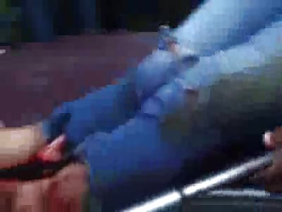 Busted leg and face from a car accident.