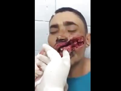 Devastating Machete Wound to Face