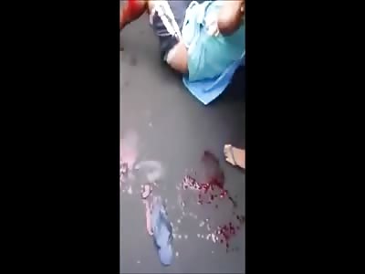 Boy has torn leg after kicking a bus tire