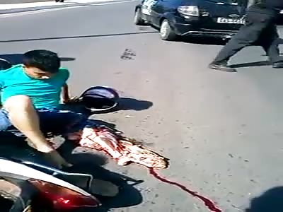 man had the torn leg in accident 