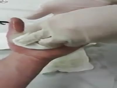 MEGA AMPOLLA EN LA PALMA DE LA MANO!!!