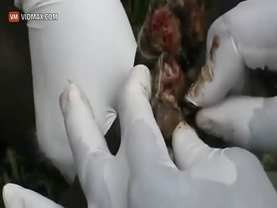 Feet infested by pregnant Chigoe flea's being removed.